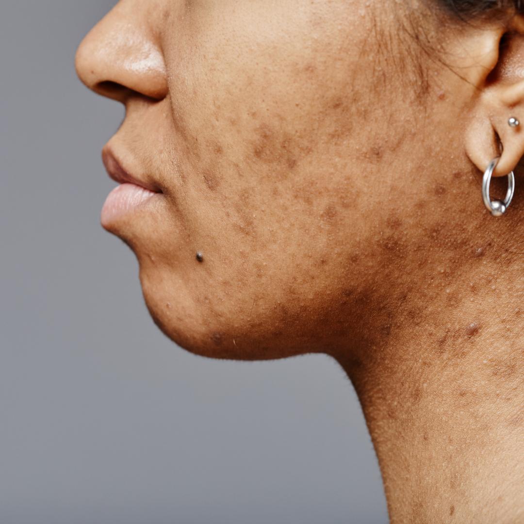 Pigmentation 2