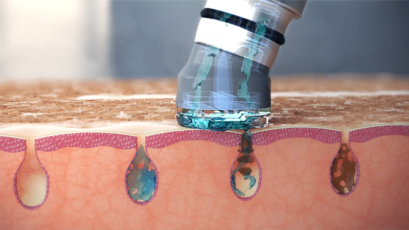 Hydradermabrasion